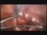 Single Incision Laparoscopic Polymyomectomy • Video • MEDtube.net