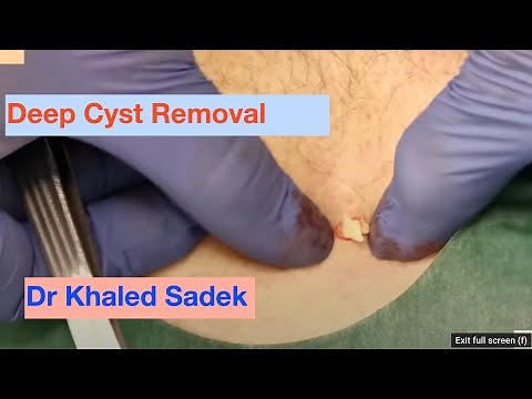 Deep Cyst Removal. Dr Khaled Sadek. LipomaCyst.com