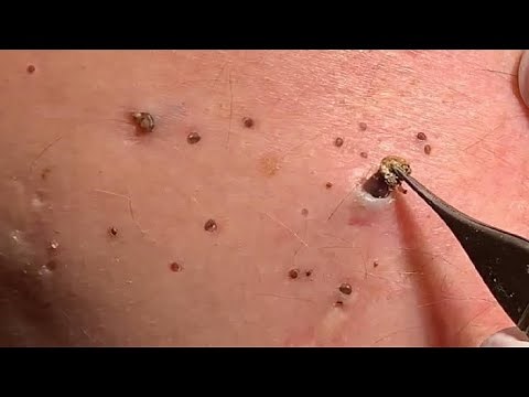 Blackhead removal