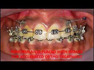 BRACES AND MINI IMPLANT TREATMENT IN KONDAPUR / SHERILINGAMPALLI VK DENTAL BEST BRACES CLINIC