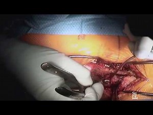 Lumbar Fusion - live surgery with Rod Oskouian, MD⠀