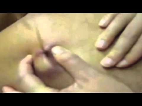 Abscess & Pimple Popping Compilation boil pus zit cyst YouTube