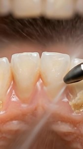 💓😳 #ขูดหินปูน #ASMR #CalculusRemoval #TeethCleaning #ScalingTeeth #PlaqueAndTartar #OralCare #ຂູດຫິນປູນ #DentalHygiene #BeforeAfterTeeth #CleanASMR #CloseUpASMR | Stamp Sinwised