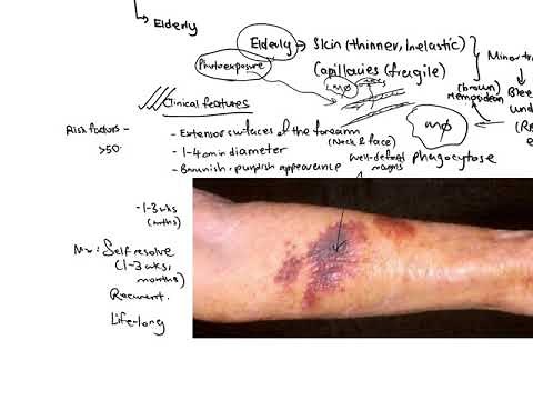 Haematology - Senile purpura