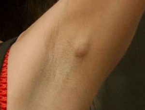 Painful Lump in Armpit Pictures, Treatment of Sore, Large or Pea Sized Underarm Lumps – Treat, Cure Fast