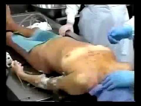 autopsy 1