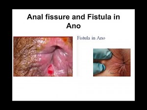 Fissure and Fistula in ano