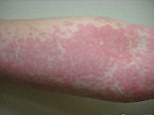 What is the rare skin condition Solar Urticaria? | Daily Mail Online