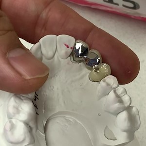 3-Unit Metal Ceramic-PFM Posterior Bridge, with Metal Lingual Surfaces and a Metal Rest. Case from Dr. Miles Jacobsen in Kansas. | CEO Luke Kahng