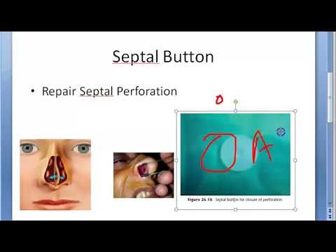 ENT Septal Button Septum Perforation Causes Nose Nasal Treatment Silastic