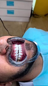 کوردی | عربي ئەنجامدانی هۆڵیوودسمایڵ بۆ چارەخوازێک لە لایەن د.شوان جەمالەوە بۆ زانینی نرخ تەنها لە کۆمێنت وشەی (نرخ) بنووسە هولیود سمایل من قبل د.شوان جمال لمعرفة السعر فقط أکتب کلمة (السعر) في التعلیق سەنتەری ددانی لیبرتی سلێمانی: ئیبراهیم پاشا، تەنیشت مزگەوتی سەلیم بەگ 07701529396 #سەنتەر #ددان #لیبرتی #سپیکردنەوە #لەیزەر #سلێمانی #هۆڵیود #سمایڵ #پڕکردنەوە #زڕگۆن #کیف #چاندن #چارەخواز #سیرامیک #هولیودـسمایل #اسنان #طبیب #زرع #تبیض #dental #Liberty # #Ceramic #implant #Center | Liberty Dental C