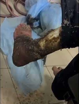 Inside the OR with ‪@justageneralsurgeon‬ - myiasis (fly larvae) infestation in a necrotic wound!