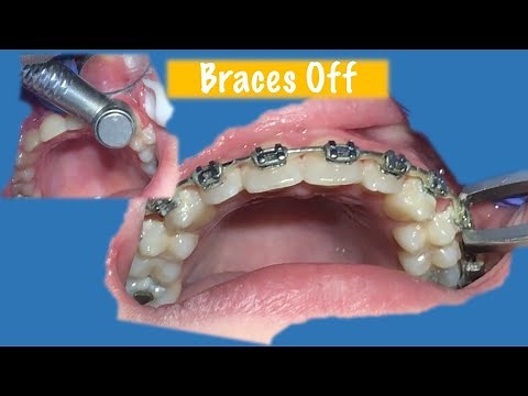 Getting Braces Removed