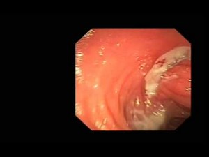 Small Bowel, Abnormal Post Surgical Anatomy, Ulcer and Granluation Tissue Following Stent Removal