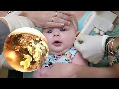 Removal of Ear Wax From Young boy