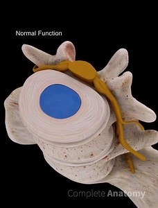 Nerve routes extend from the spinal cord through the openings of each side from the cervical vertebrae. Intervertebral discs located between the vertebrae prevent friction and allow for smooth movement between vertebrae. A herniated disc may occur due to degeneration of the disc, or from rupture of the disc, secondary to trauma. The herniated disc compresses the spinal nerve route against the vertebra. This results in pain, numbness, or weakness along the involved arm or hand. #completeanatomy #