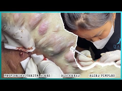Big Cystic Acne Blackheads Extraction Blackheads & Milia, Whiteheads Removal Pimple Popping
