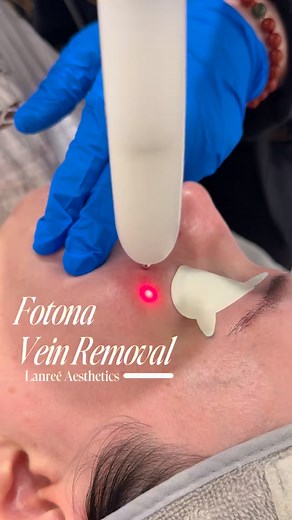 ✨FOTONA VEIN REMOVAL Laser✨ Spider Veins, Red Veins, Capillaries and Vascular Lesions can now be treated by our latest Fotona 4D Pro Laser Device. 🎀 This treatment is ideal for vascular damage, visible capillaries and spider veins. This treatment uses targeted thermal energy to penetrate deep into the skin to reach deep-lying facial veins and repair vascular damage. This treatment is quick, simple, includes no needles, and offers little to no downtime. If you are interested in learning more abo