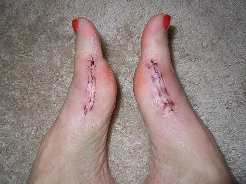 Guaranteed Best Bunion and Hammer Toe Surgery Recovery: **10 day guide!**