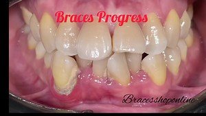 Braces can take around two years to gradually move teeth into their desired positions. However, the time it takes can vary depending on the severity of the case and how well the patient follows the treatment plan. In some cases, teeth can be straightened and properly spaced after about six months of treatment. In other cases, it can take two years or more. #braceschristmascolors #perfectcolorforbraces #bracestipsandadvice #dentalideas #braceslife #bracescare #bracestips #everyone #followers #bra