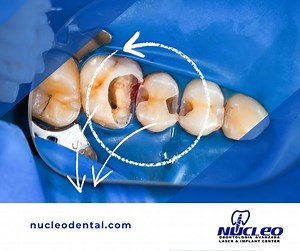 Fillings are used to treat a small hole, or cavity in a tooth. Dentists remove decayed tooth tissue and fill it with material. Learn more. . Phone: 915 308 0101 nucleodental.com . #NucleoDental #ElPasoTx #CiudadJuarez #NewMexico #dentalclinicnearme #oralcare #oralhealth #dentaltourism #dentaltourismmexico #dentalimplantsmexico #dentalimplantsjuarez #bestdentalserviceintown #cosmeticdentistry #dentalservice #orthodonticservice #fullmouthrehabilitation #americaninsurance #transportationservice #de