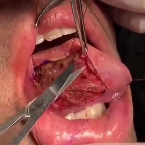 Oral Cancer Surgery