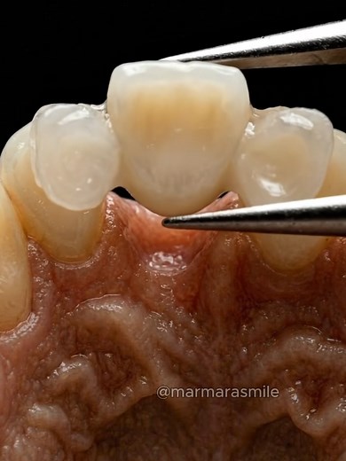 Kissing the Pavement: A Dental Bridge Story