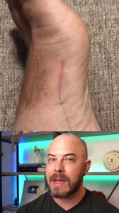 A hair splinter happens when a strand of hair pierces through the top layer of your skin. They can be very painful, especially when infected