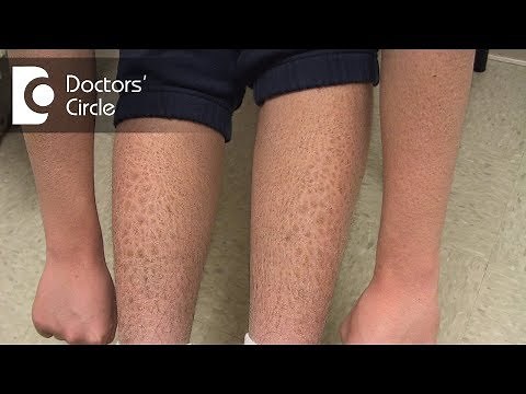 How to manage Ichthyosis Vulgaris in teenage boys? - Dr. Nischal K