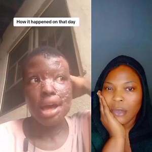 Lady shares how her husband of 9years poured acid on her face and left her disfigured 😪 #highlight #trend #viralpost #fypシ゚viralシfypシ゚viralシalシ #fypシ゚viralシfypシ゚ #reelsviralfb #reelsviralシ #reelsfbシ | Oji Victoria Ivuoma