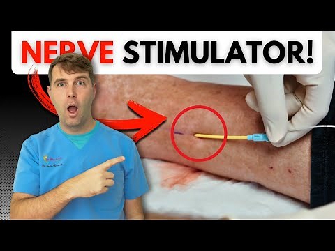 New Nerve Stimulator Treatment 💥 for Chronic Foot Pain & Neuropathy 🦶