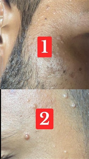 Wart | Molluscum contagiosum | Wart removal #shorts #skincare #warts