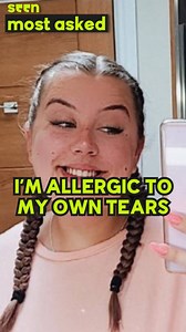 Water Makes Me Break Out In Hives 'Once my skin has been in contact with water, my skin will break out into red and itchy hives.' Abbie has a water allergy that means she breaks out in hives any time she's in the rain, in a shower or even when she starts crying. | seen.tv