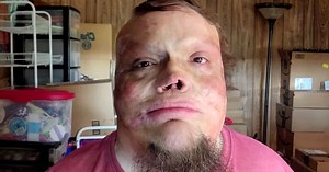 ‘God Was With Me’: Burn Survivor With 1% Chance of Survival Inspires Thousands With His Story | Inspirational Christian Stories and Positive News