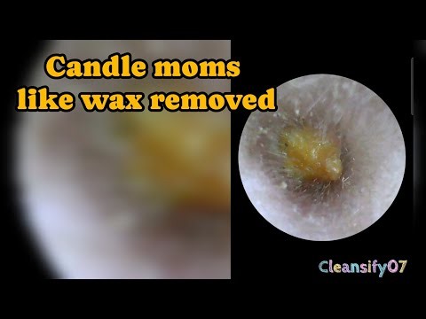 Candle moms like ear wax removed ||moms like ear wax removed easily #otomycosis #earwaxremoval #asmr