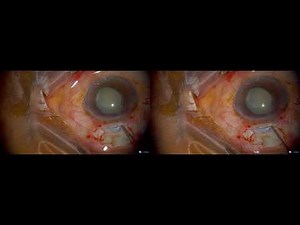 Manual Small Incision Cataract Surgery - 3D: Dr. Rishi Swarup