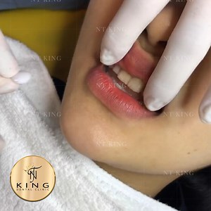 217K views · 3.4K reactions | DÁN SỨ KHÔNG MÀI NHỎ RĂNG THẬT • Không...