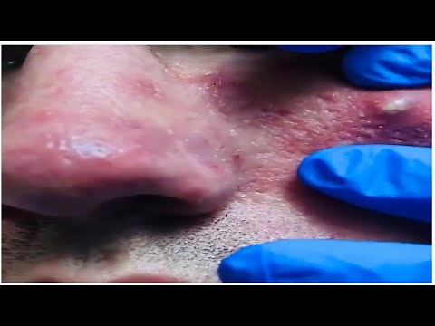 Amazing Top 10 abscess removal || Massive cyst drainage