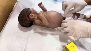 34K views · 742 reactions | NEC Baby | Abdominal Distention Management | Suppository & NG Tube Procedure | NICU Care #baby #cry #newborn #newbornbaby #nicu | Ak Gautam | Facebook