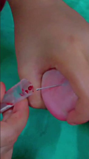Newborn Screening Blood Spot Test | Heel Prick Sample Collection