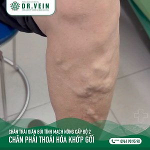 TREATING AN ELDERLY PATIENT WITH CONCURRENT C2 VARICOSE VEINS AND...