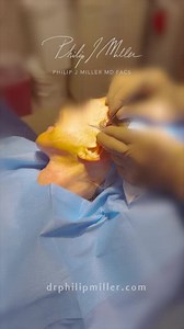 MicroLift, aka Ponytail Lift