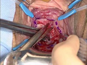 Excision of Transvaginal Mesh Extrusion
