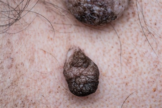 What Do Cancer Moles on Dogs Look Like? – Top Dog Tips