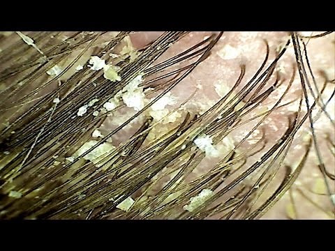 Seborrheic Dermatitis - Adult Cradle Cap (Magnified)