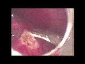 Laparoscopic ( Organ Preserving) management of Congenital splenic cyst- case series