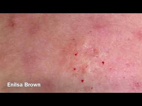 Gabriela's 2nd Acne Treatment: Blackheads Extractions