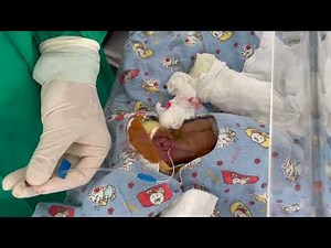 350 g preterm neonate for CV catheter insertion - Dr Kapila Hettiarachchi, Consultant Anaesthetist.