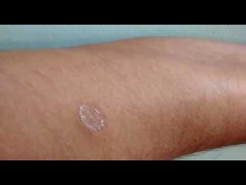 Best fungal skin infection cream | ring guard | ringworm treatment results
