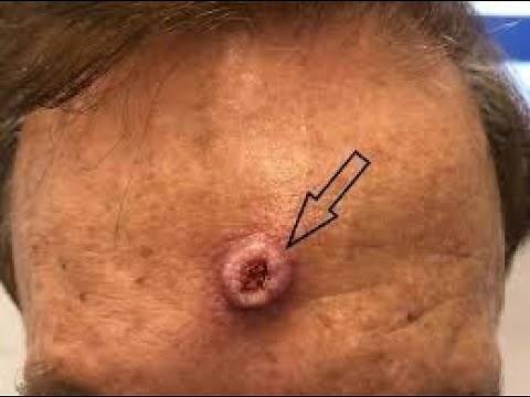 What is Keratoacanthoma?: Causes, Risk Factors, Symptoms, Lecture, Pathology, Treatment, Diagnosis